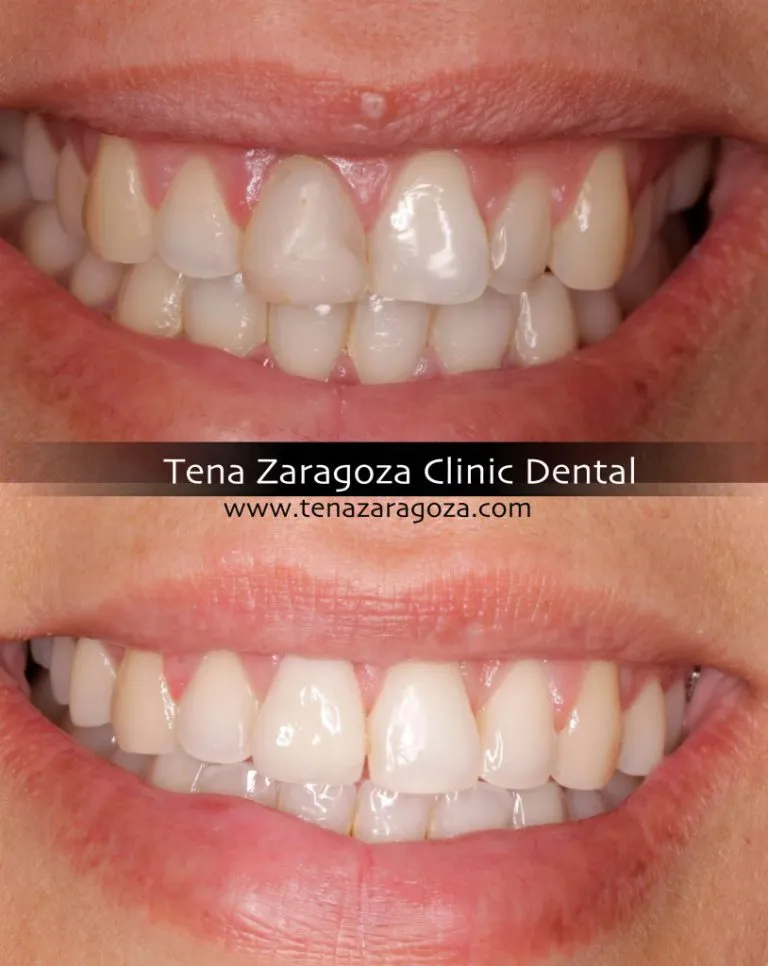 Clinica Dental Tena Zaragoza Implangología Y Ortodoncia Ana Ant