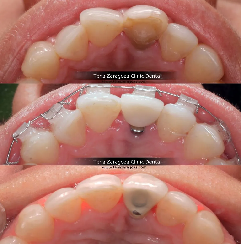 Clinica Dental Tena Zaragoza Implangología Y Ortodoncia Ana Post