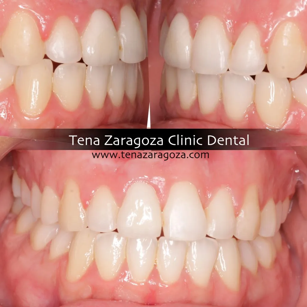 Clinica Dental Tena Zaragoza Implangología Y Ortodoncia Ana Rest