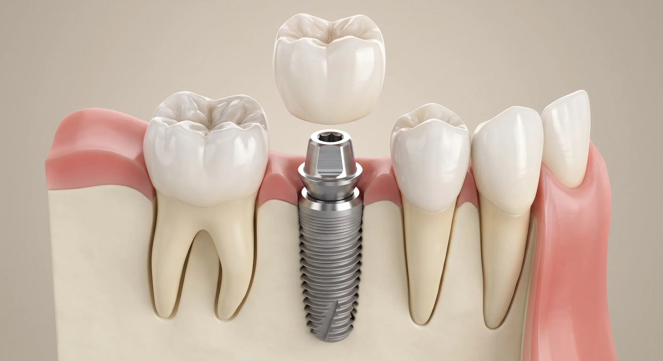 Clinica Dental Tena Zaragoza Implantología Oral