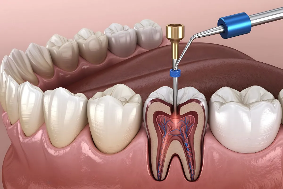 Endodoncia Clinica Dental Tena