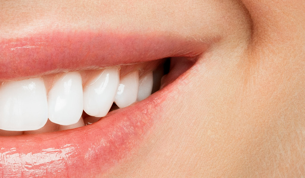 estetica-dental-blanqueamiento-despues